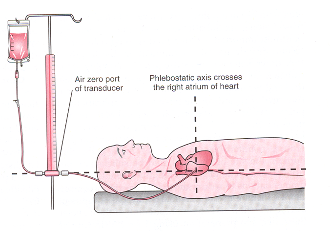 phlebostatic axis.png